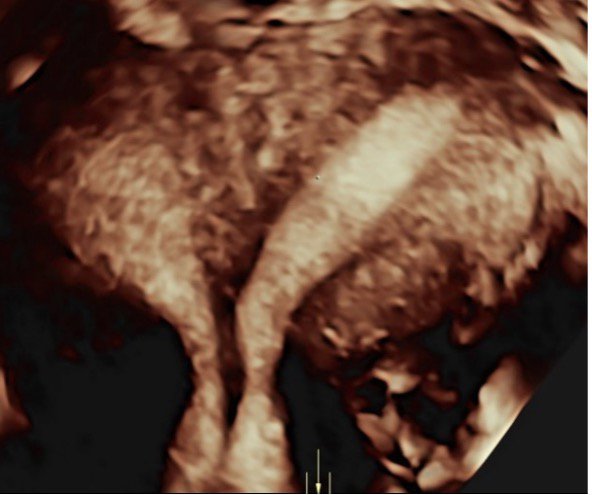 3D: Gebärmutteranomalie (doppelt angelegt)